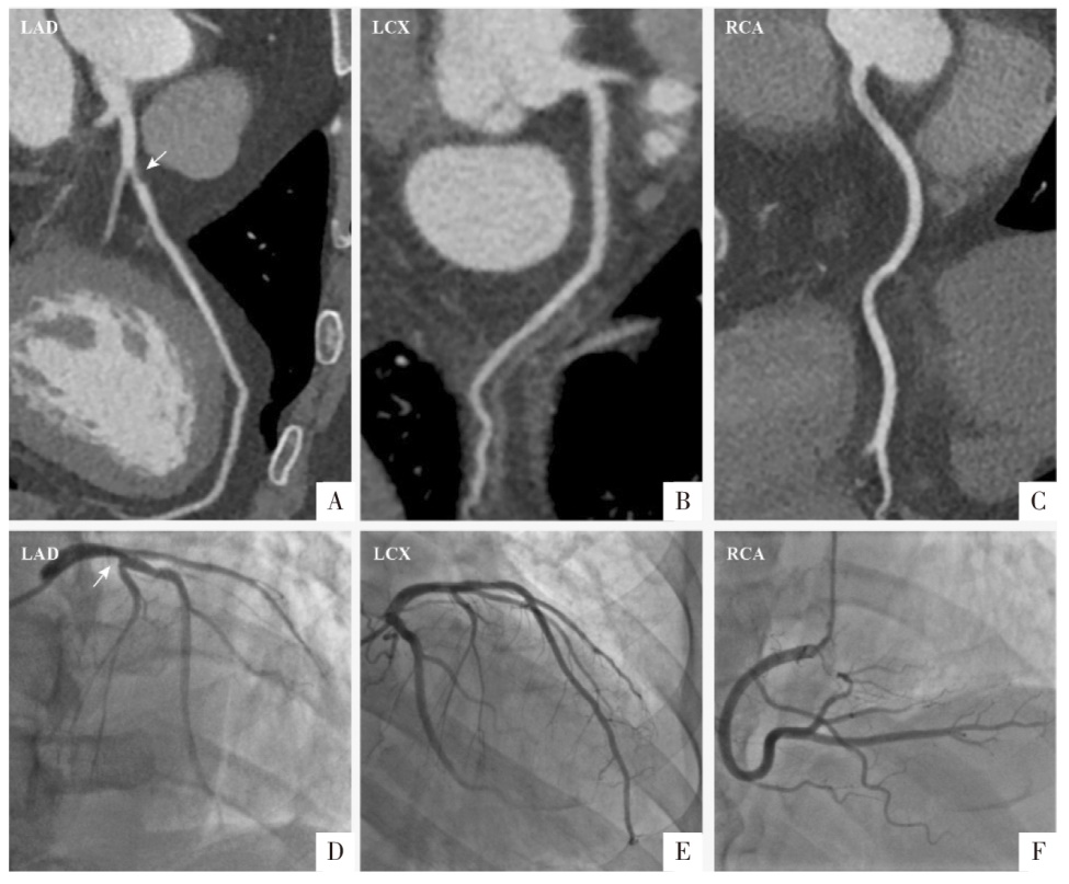 A comparative study of true ECG-gating and virtual ECG-gating techniques in  coronary CT angiography